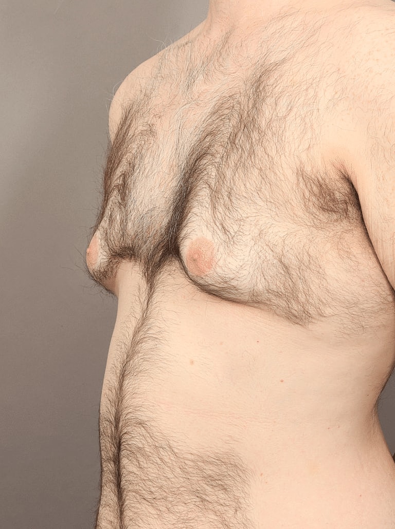 Liposuction Before & After