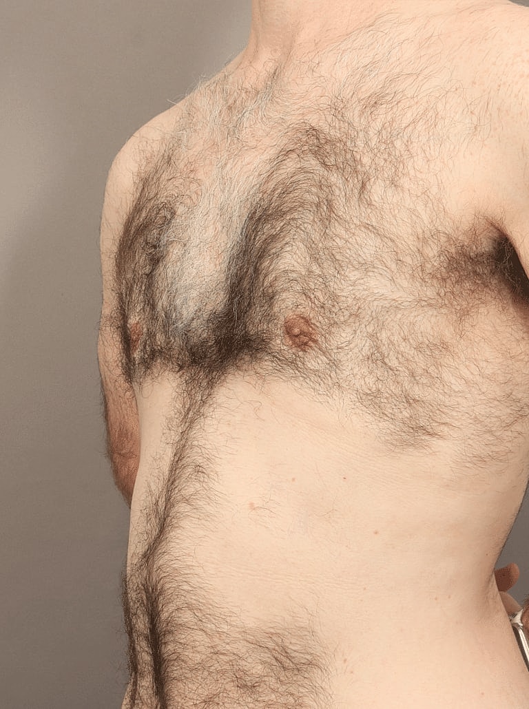 Liposuction Before & After