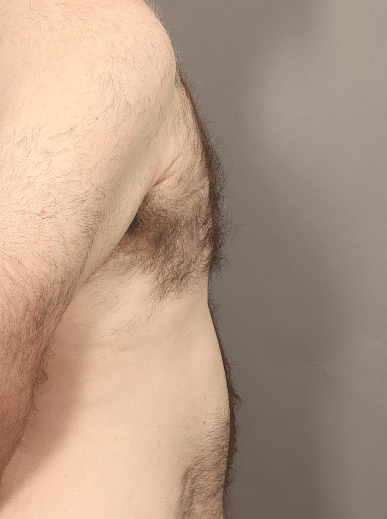 Liposuction Before & After