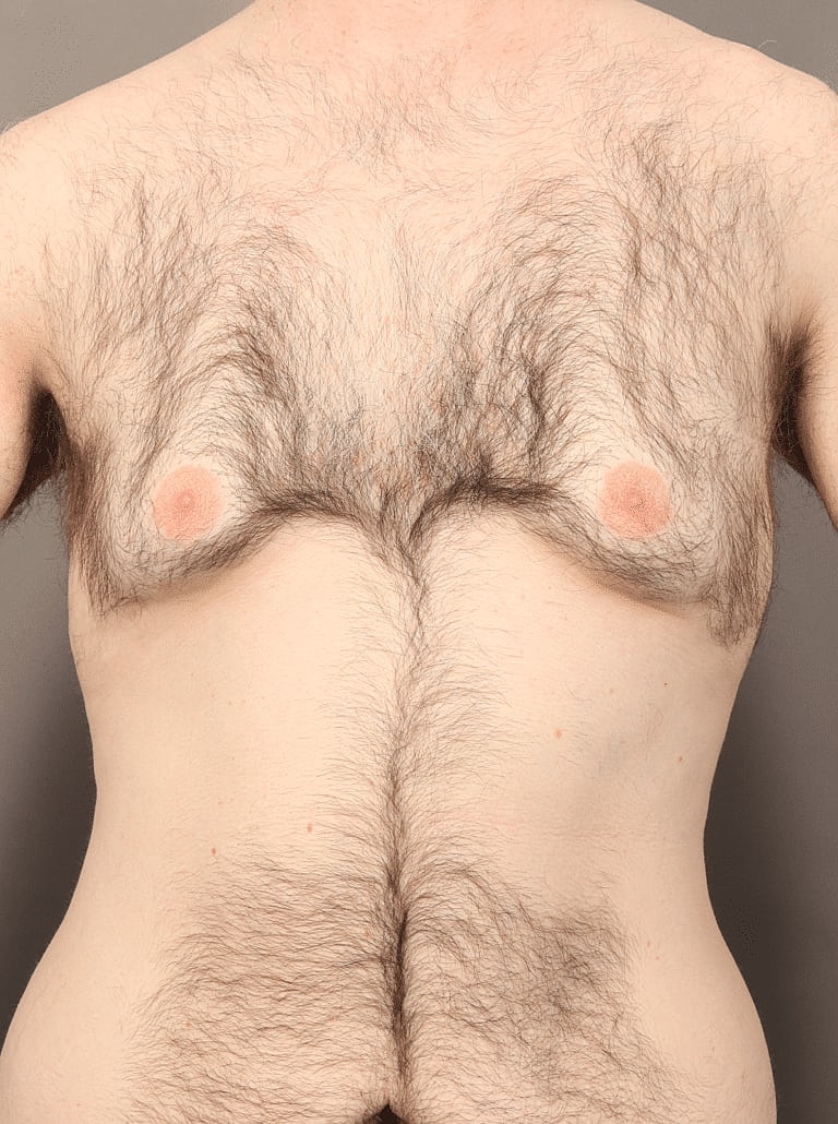 Liposuction Before & After