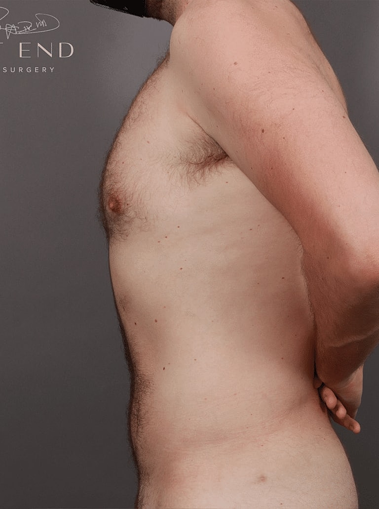 Liposuction Before & After