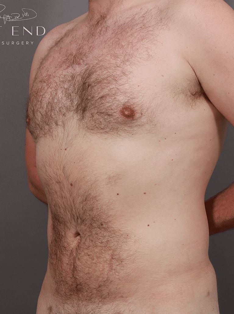 Liposuction Before & After