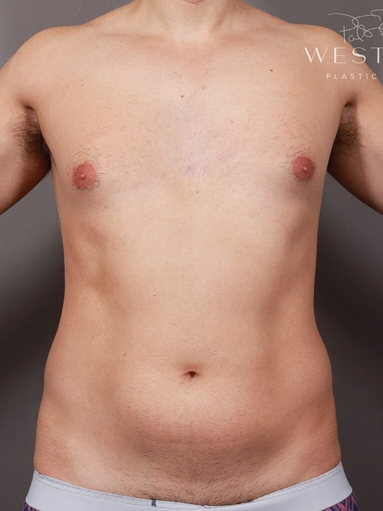 Liposuction Before & After