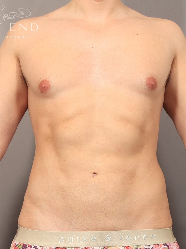 Liposuction Before & After