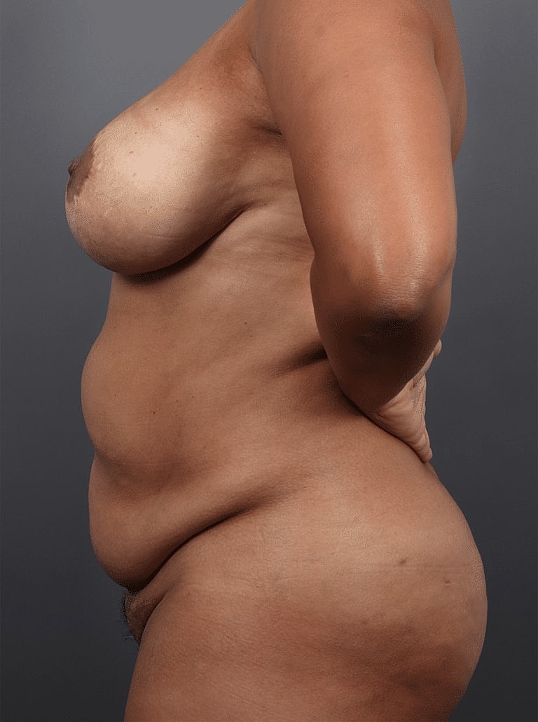 Liposuction Before & After