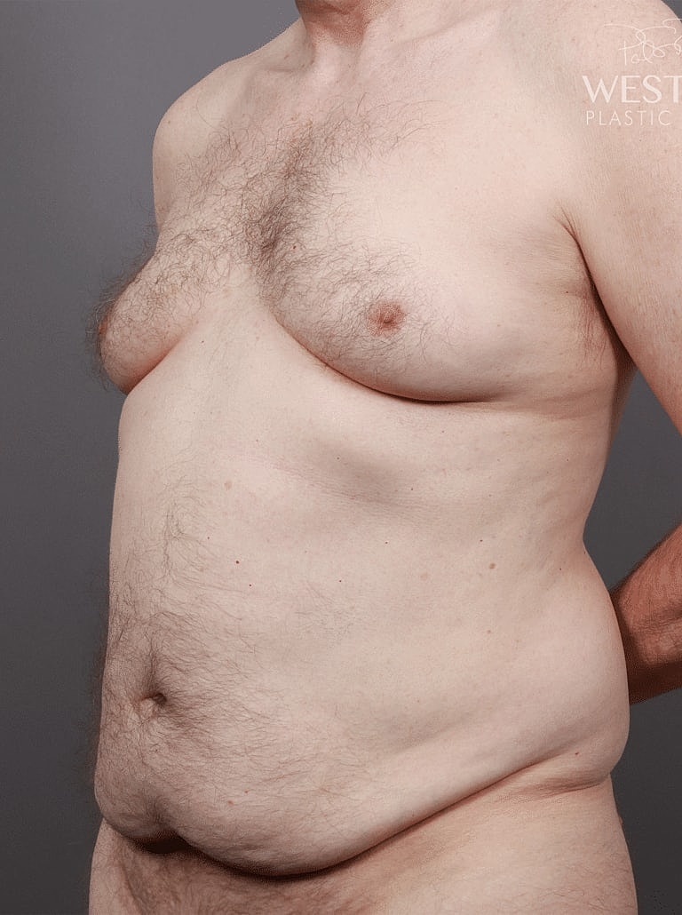 Liposuction Before & After