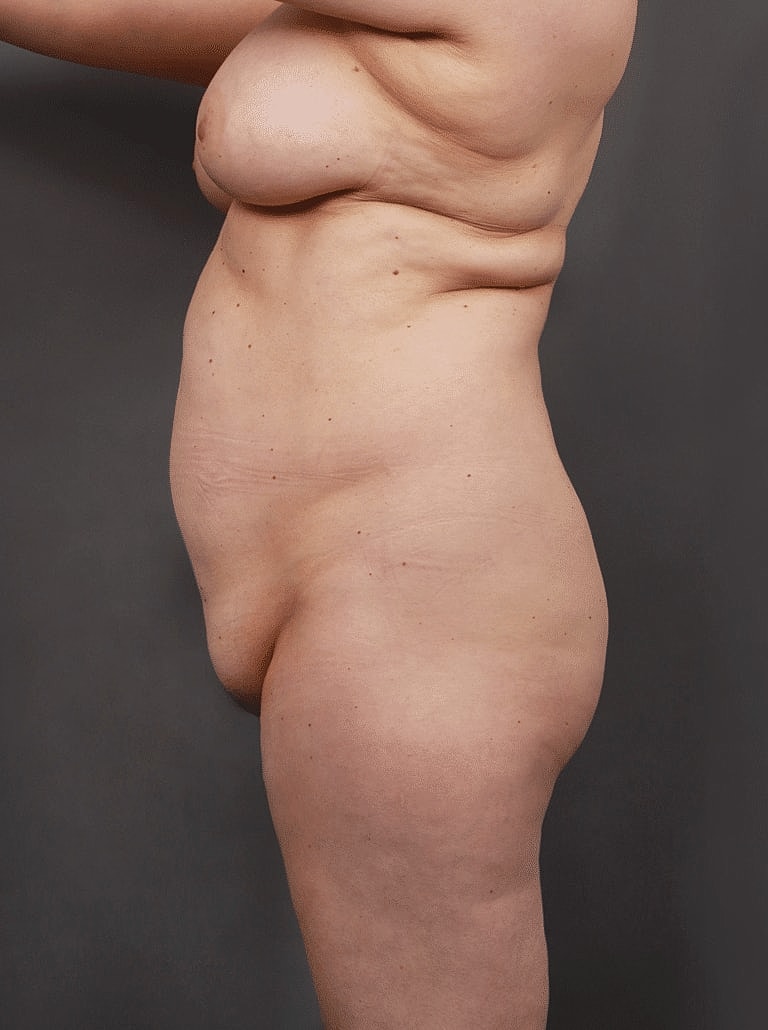 Liposuction Before & After