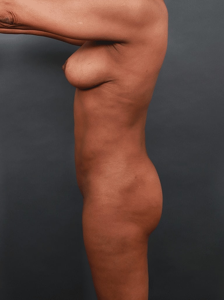 Liposuction Before & After