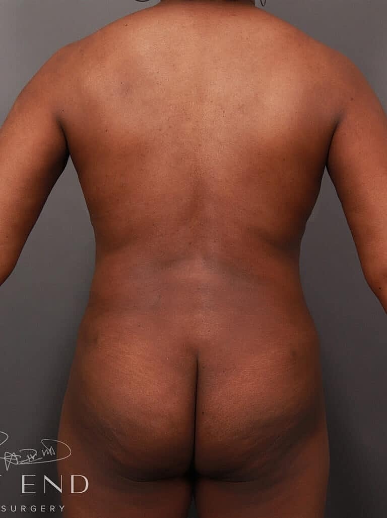 Liposuction Before & After