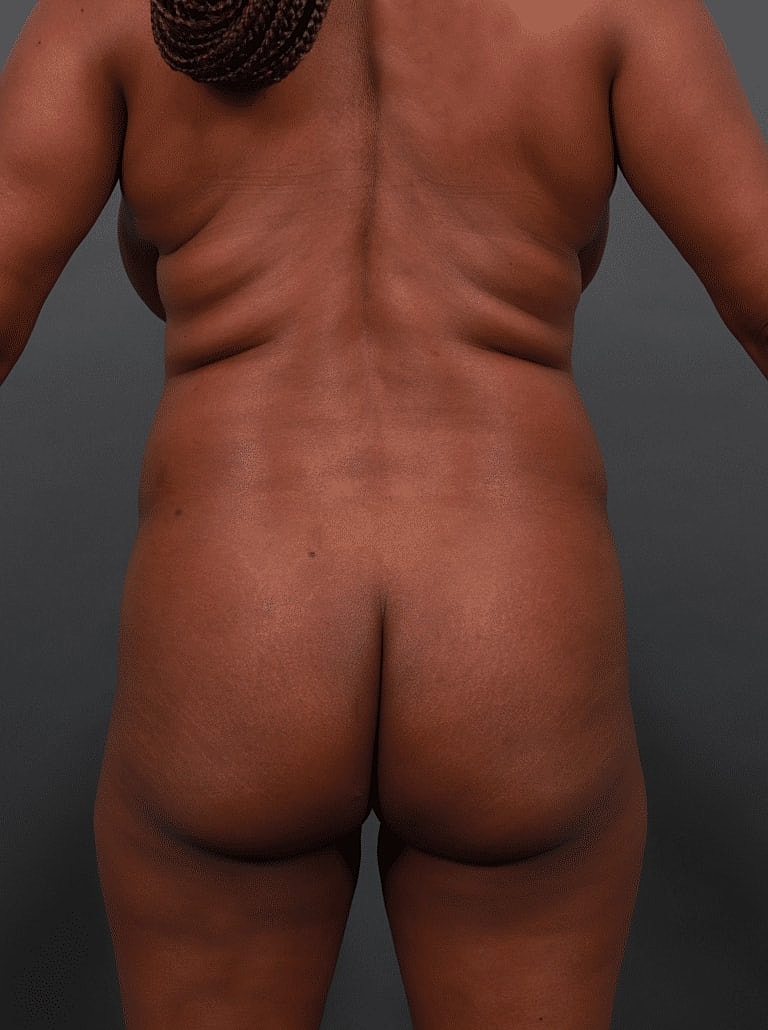 Liposuction Before & After