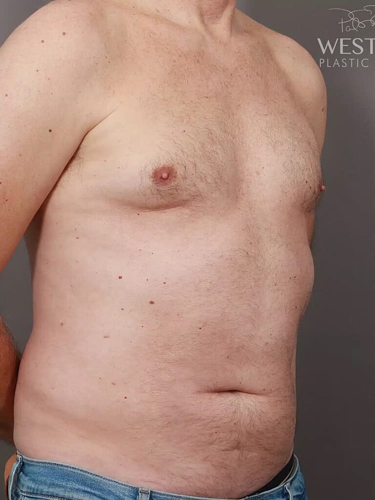Liposuction Before & After