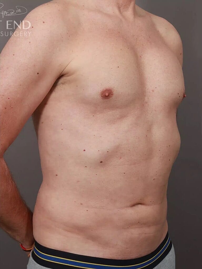 Liposuction Before & After