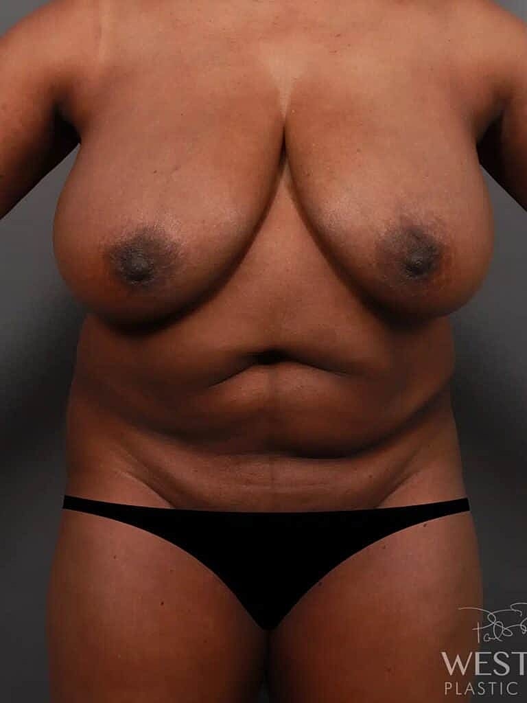 Liposuction Before & After