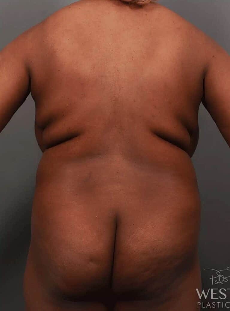 Liposuction Before & After