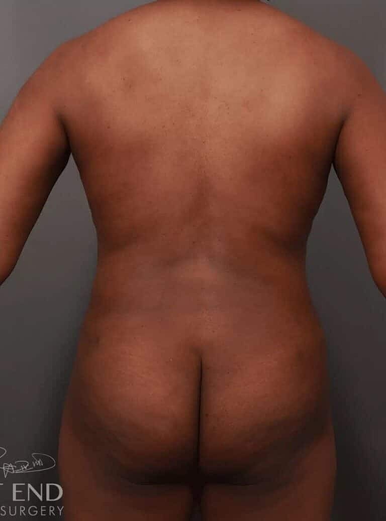 Liposuction Before & After