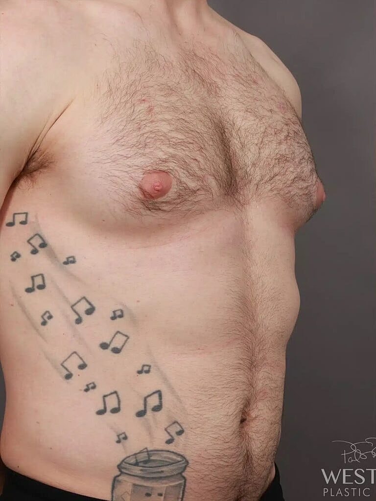 Liposuction Before & After