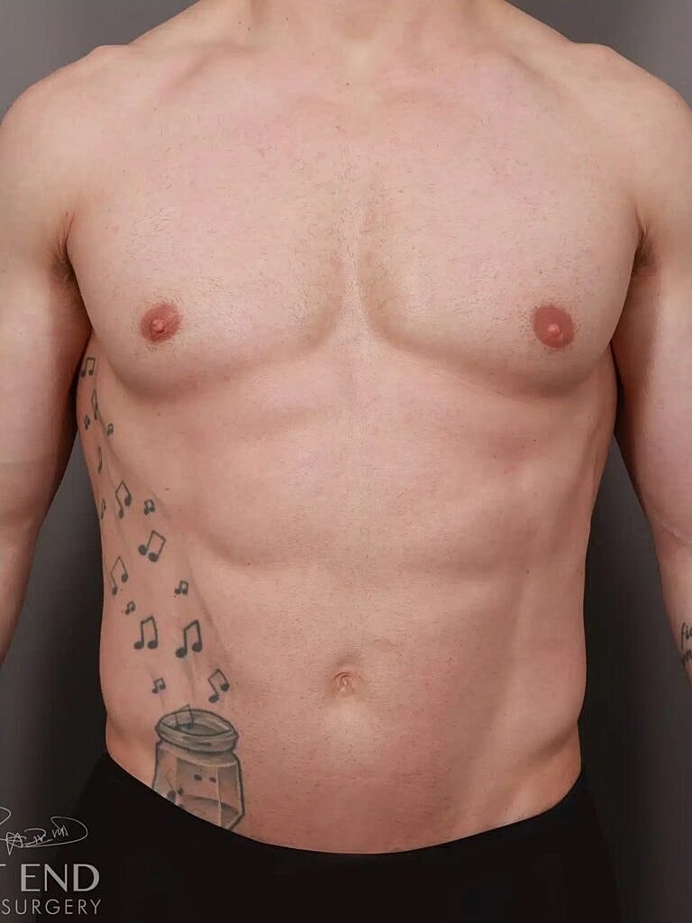 Liposuction Before & After