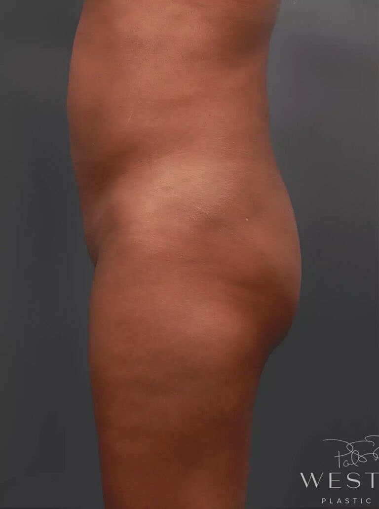 Liposuction Before & After