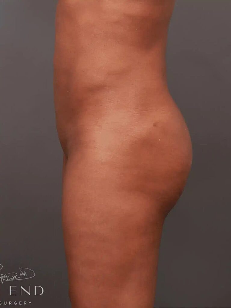 Liposuction Before & After