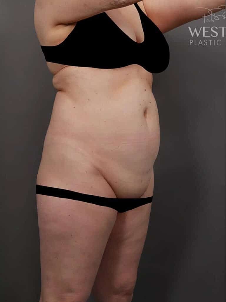 Liposuction Before & After
