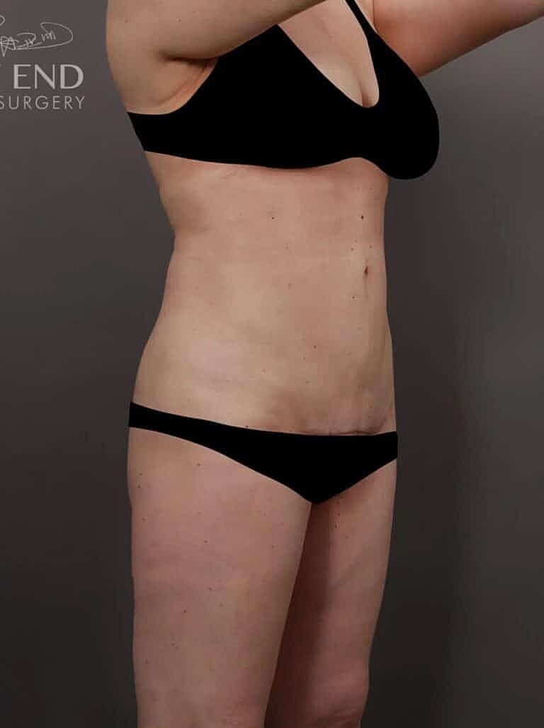 Liposuction Before & After