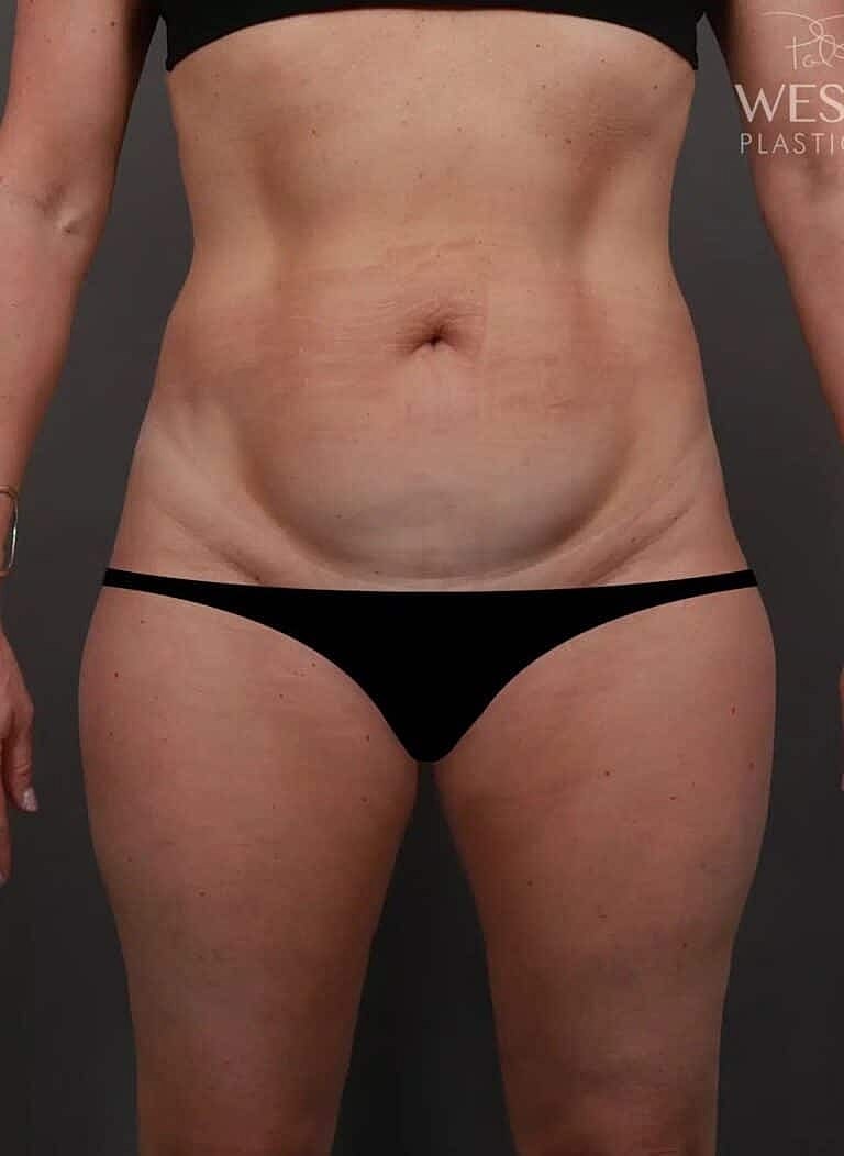 Liposuction Before & After