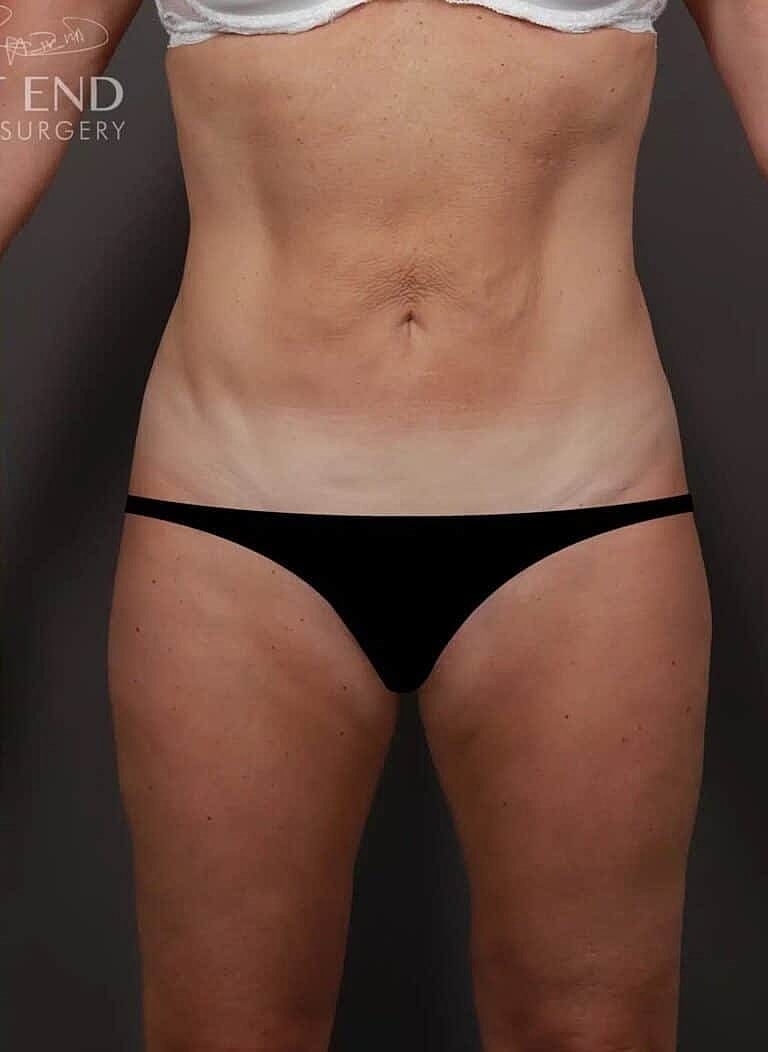 Liposuction Before & After