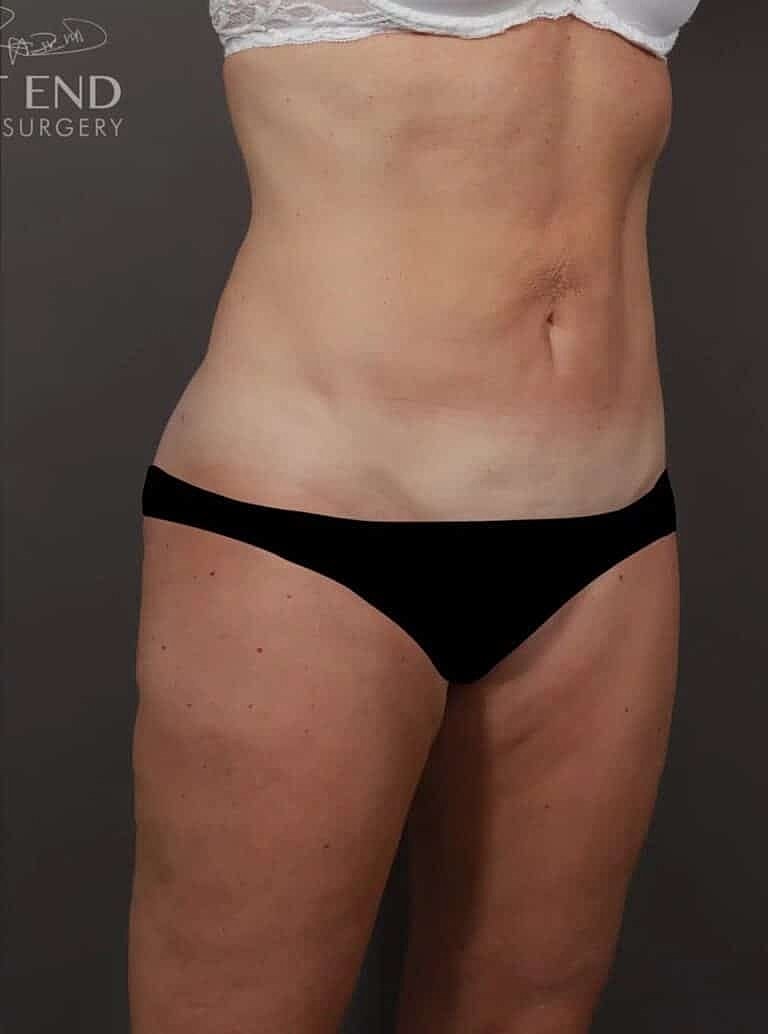 Liposuction Before & After