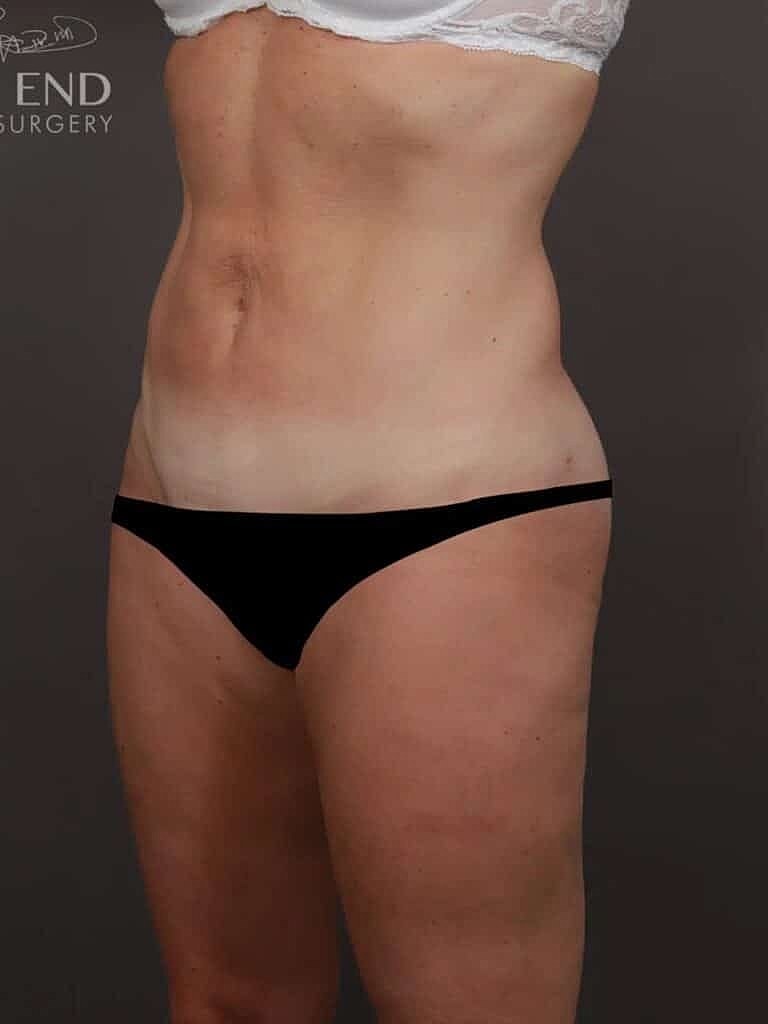 Liposuction Before & After