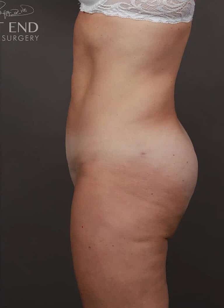 Liposuction Before & After