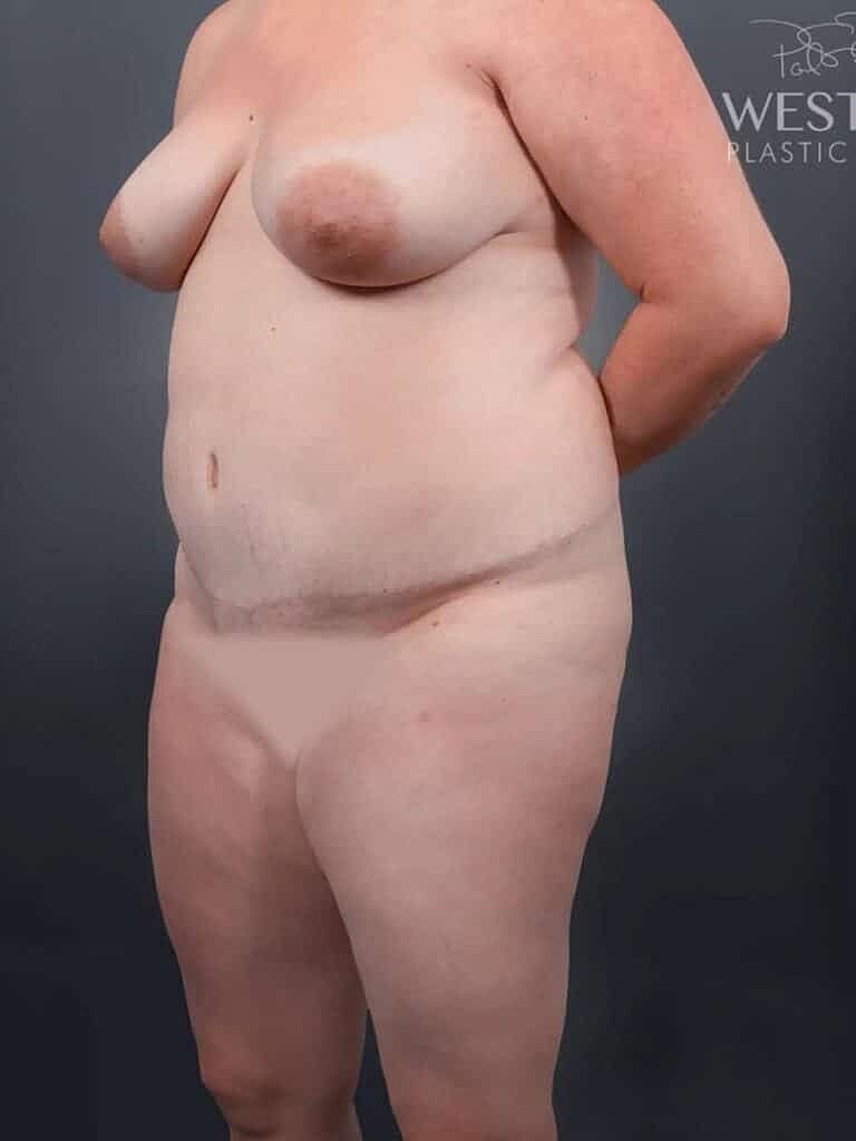 Liposuction Before & After