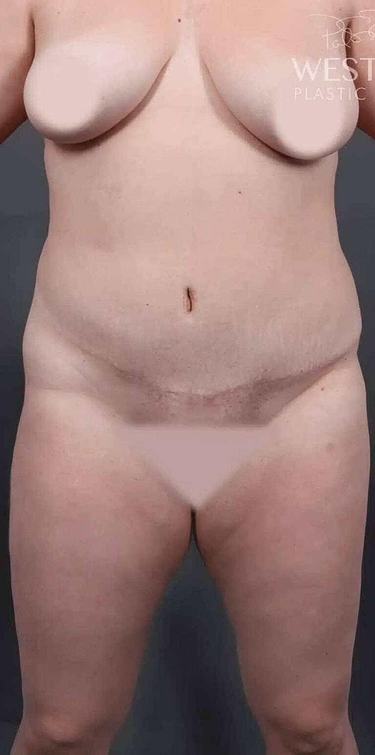 Liposuction Before & After