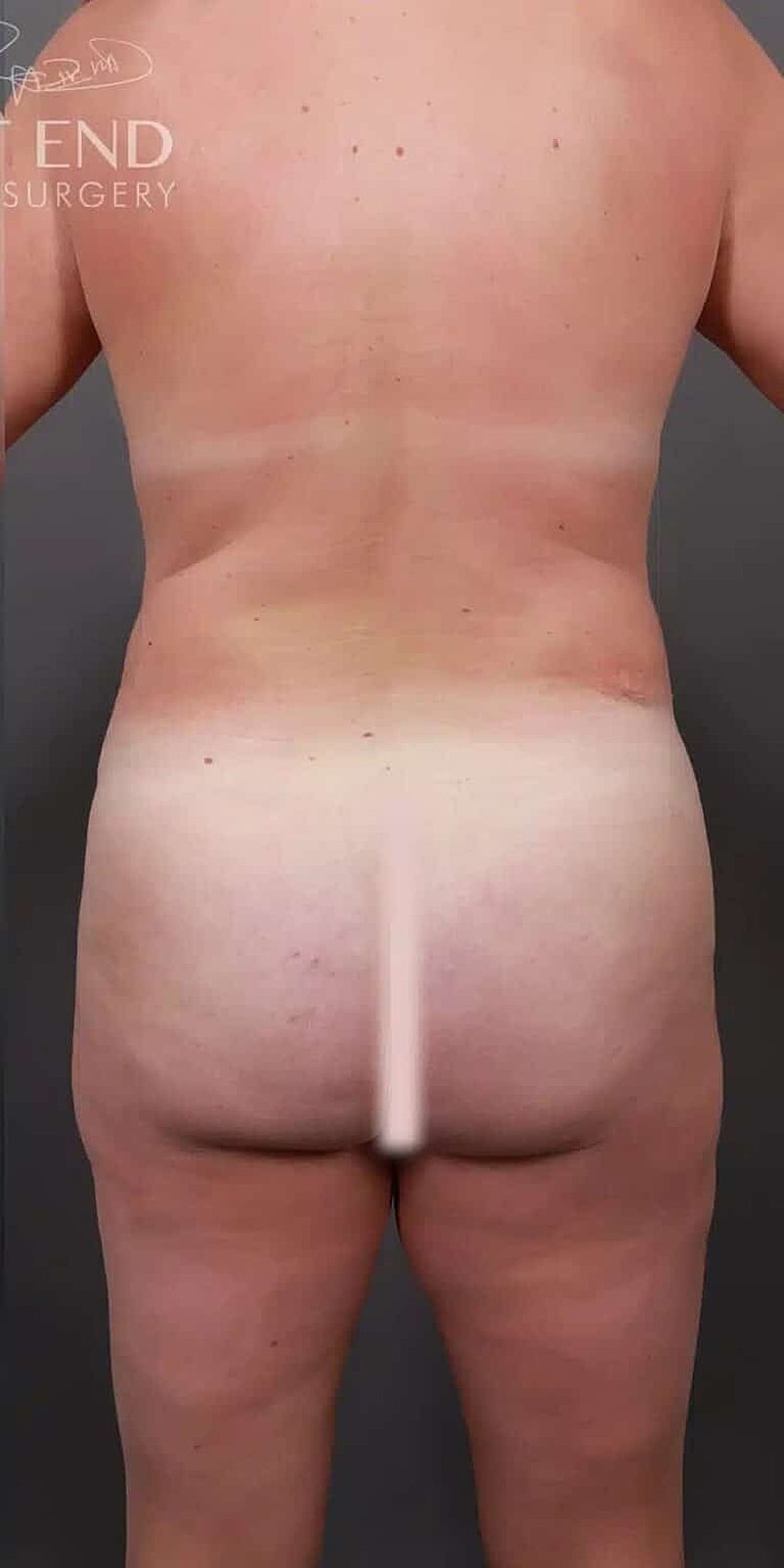 Liposuction Before & After