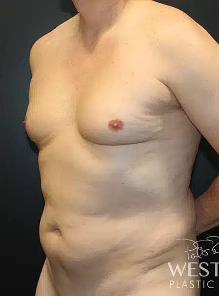 Liposuction Before & After