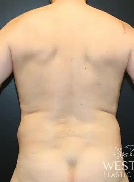 Liposuction Before & After