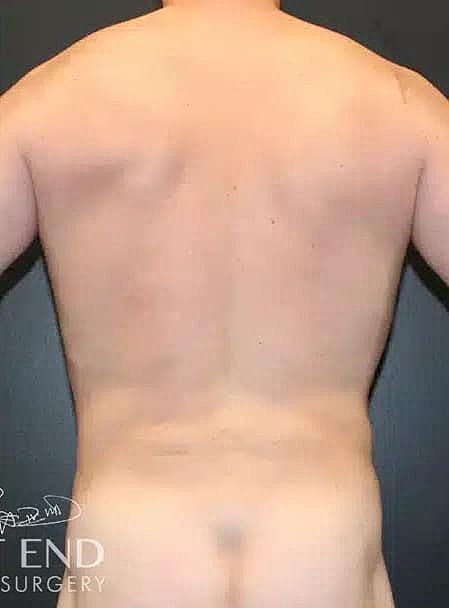 Liposuction Before & After