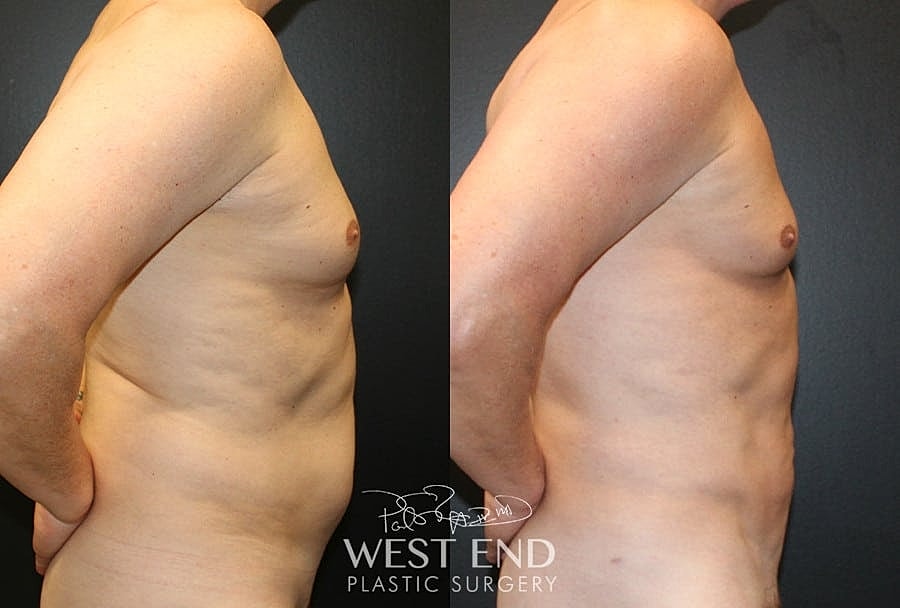 Liposuction Before & After
