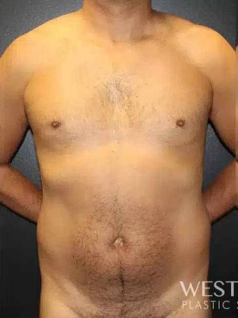 Liposuction Before & After