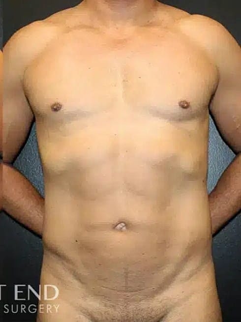 Liposuction Before & After