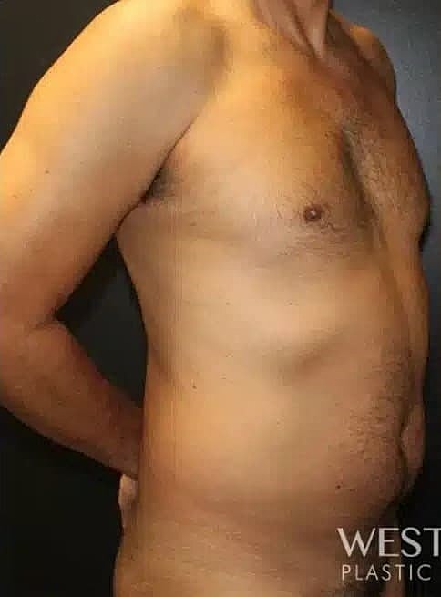 Liposuction Before & After