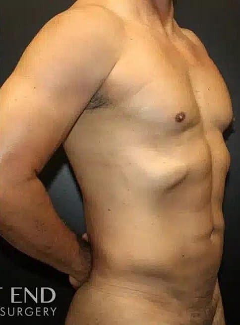 Liposuction Before & After