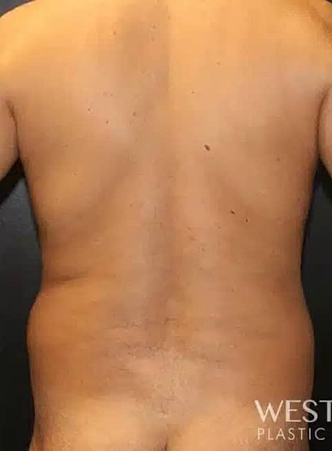 Liposuction Before & After