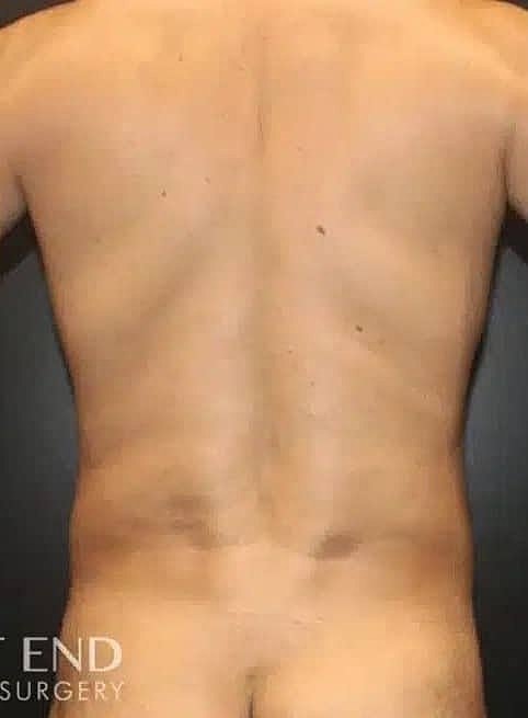 Liposuction Before & After