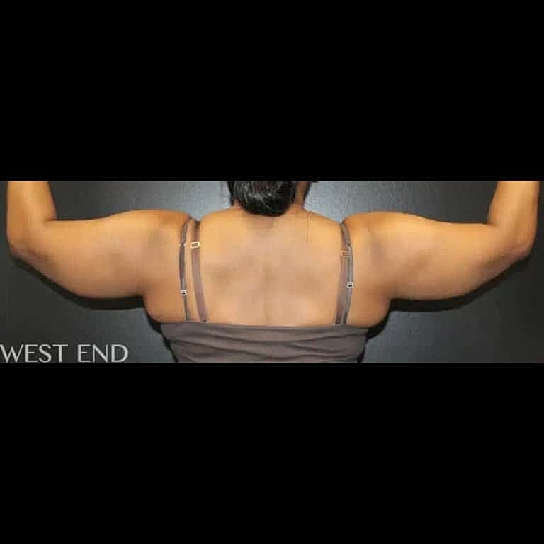 Liposuction Before & After