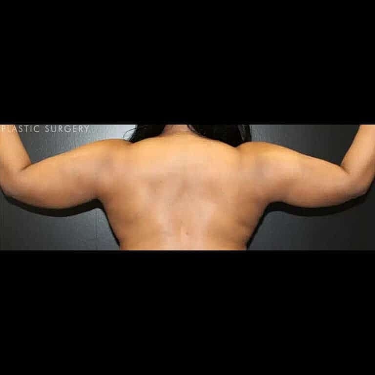 Liposuction Before & After