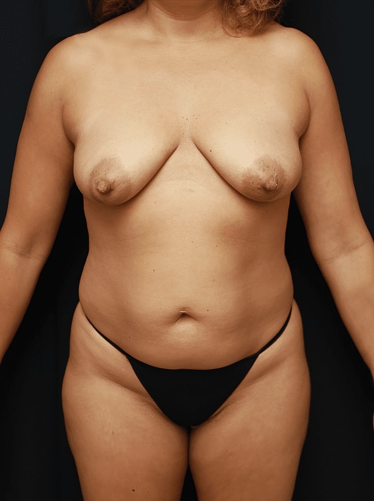 Breast Lift Before & After