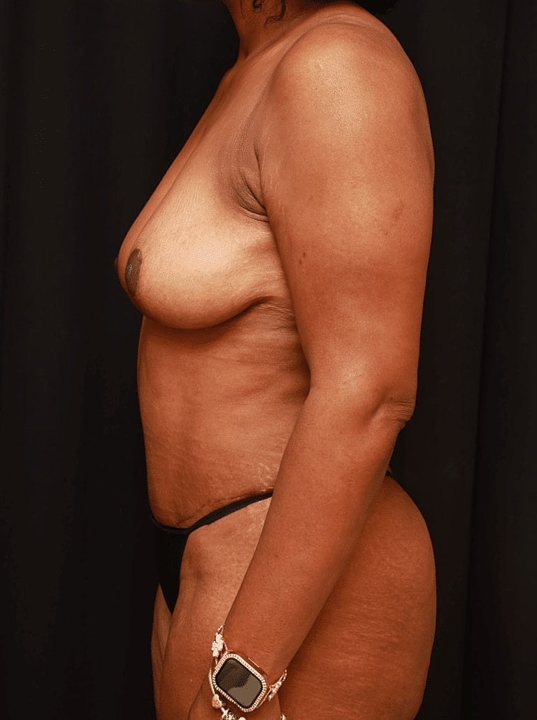 Breast Lift Before & After