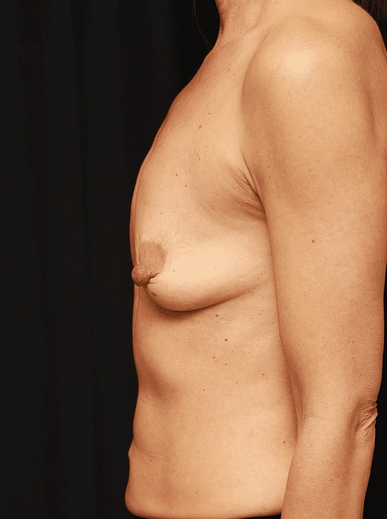 Breast Lift Before & After