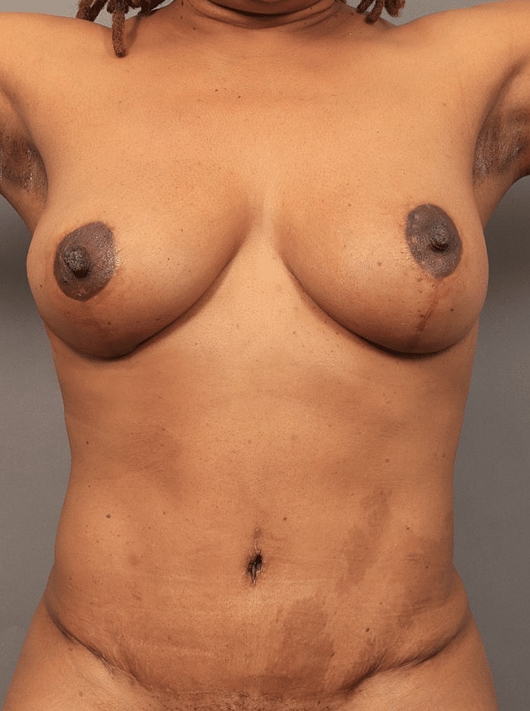 Breast Lift Before & After