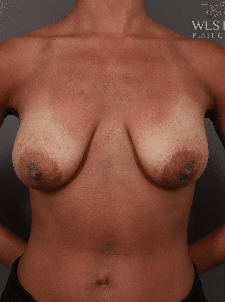Breast Lift Before & After